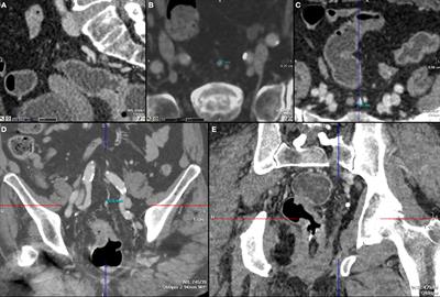 The role of superior hemorrhoidal vein ectasia in the preoperative staging of rectal cancer